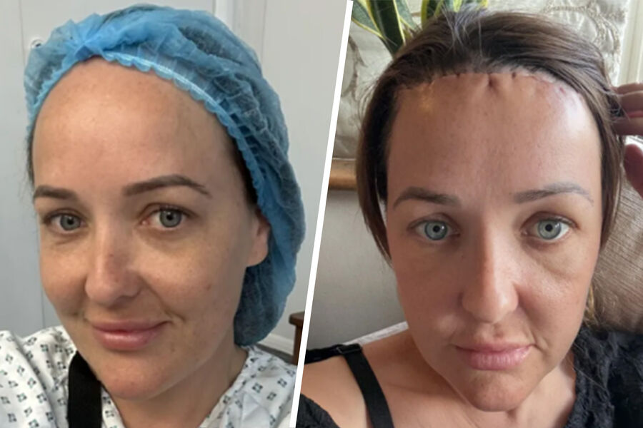 Британка уменьшила большой лоб, но по-прежнему получает комментарии о внешности