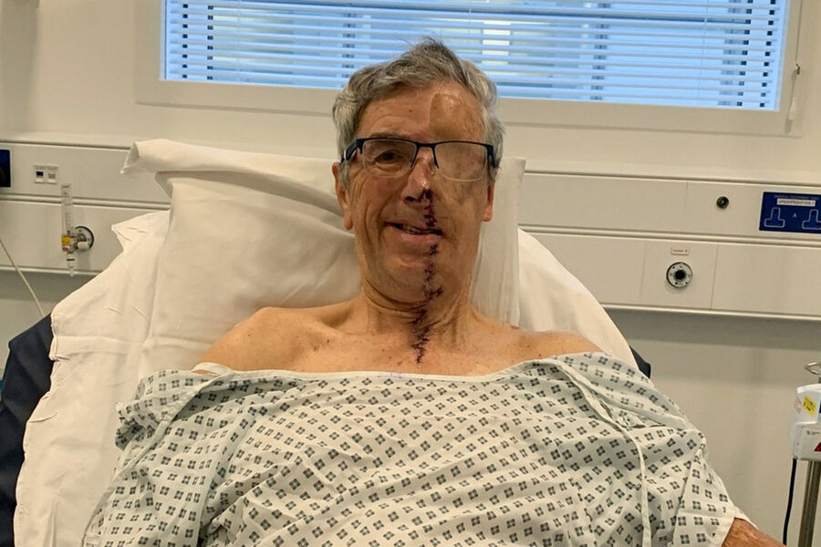 LADBible: пострадавшему в аварии британцу восстановили лицо на 3D-принтере