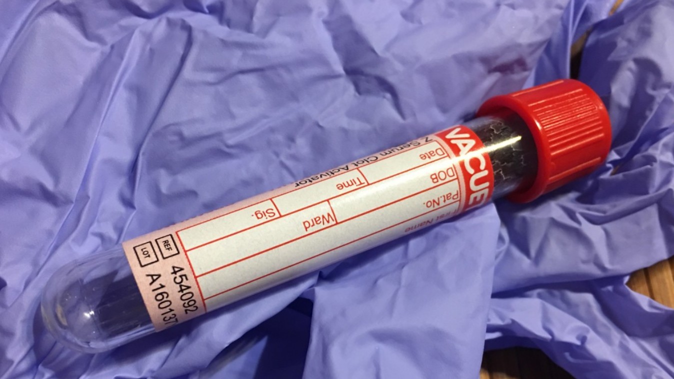 Ученые обнаружили механизм уязвимости саркомы Юинга, усиливающий действие иринотекана