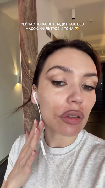 Певица Ольга Серябкина рассказала, что сожгла себе лицо домашним пилингом