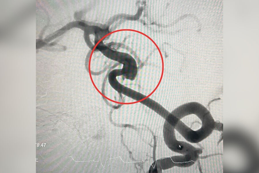 Врач Тарасова: круассаны, белый рис и сметана повышают опасный холестерин